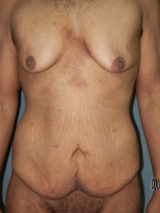 Body Contouring - Case 0065 - before front view