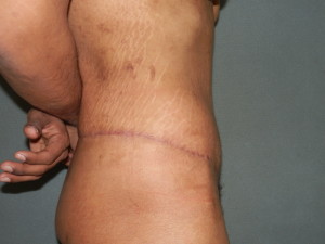 Body Contouring - Case 0065 - after side view