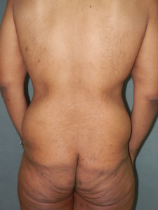 Body Contouring - Case 0065 - before back view