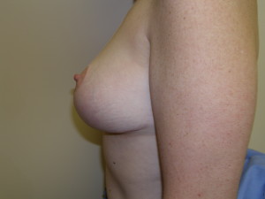 Breast Lift - Case 0504 - after side view