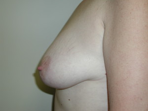 Breast Lift - Case 0504 - before side view