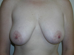 Breast Lift - Case 0504 - before front view