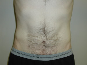Liposuction - Case 0457 - after front view