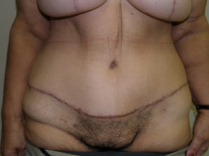 Post Bariatric Body Contouring - Case 0509 - after lower view