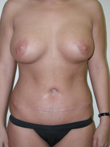 Tummy Tuck - Case 0476 - after front view