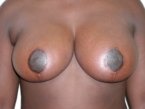 Breast Reduction - Case 0492 - after front view