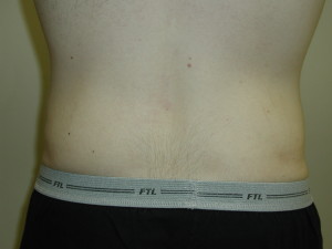 Liposuction - Case 0457 - after back view