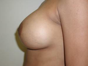 Breast Aug - Case 0440 - after side view