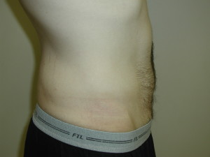 Liposuction - Case 0457 - after side view