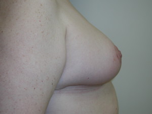 Breast Reduction - Case 0486 - after side view