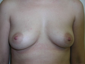 Breast Aug - Case 0157 - before front view