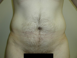Liposuction - Case 0457 - before front view