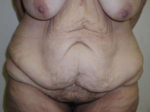 Post Bariatric Body Contouring - Case 0509 - before lower view