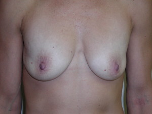 Breast Aug - Case 0435 - before front view