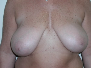 Breast Reduction - Case 0498 - before front view