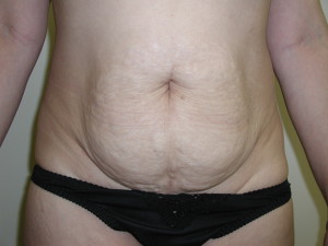 Tummy Tuck - Case 0468 - before front view