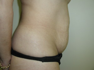 Tummy Tuck - Case 0468 - Before side view