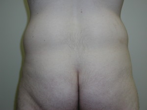Liposuction - Case 0457 - before back view