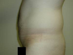 Liposuction - Case 0457 - before side view
