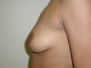 Breast Aug - Case 0440 - before side view