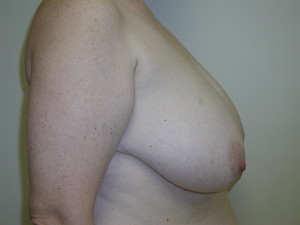 Breast Reduction - Case 0486 - before side view