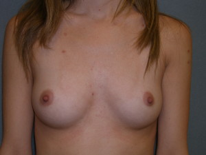 Breast Aug - Case 0142 - before front view