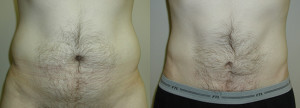 Liposuction - Case 0457 - before and after front view