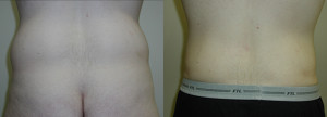 Liposuction - Case 0457 - before and after back view