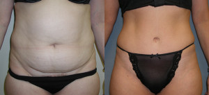 Tummy Tuck - Case 0106 - before and after front view