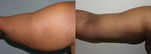 Liposuction - Case 0114 - before and after arm view