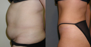 Tummy Tuck - Case 0106 - before and after side view