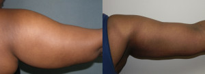 Liposuction - Case 0114 - before and after arm view