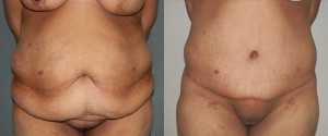 Body Contouring - Case 0073 - before and after front view