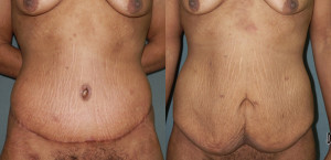Body Contouring - Case 0065 - before and after front view