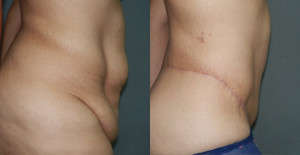 Body Contouring - Case 0099 - before and after side view