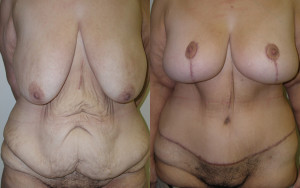 Post Bariatric Body Contouring - Case 0509 - before and after front view