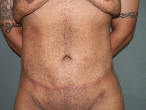 Body Contouring - Case 0085 - after front view