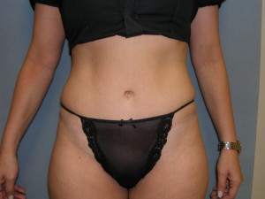 Tummy Tuck - Case 0106 - after front view