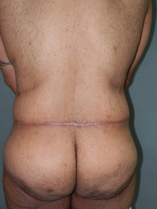 Body Contouring - Case 0085 - after back view