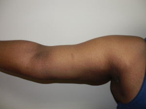 Liposuction - Case 0114 - after arm view