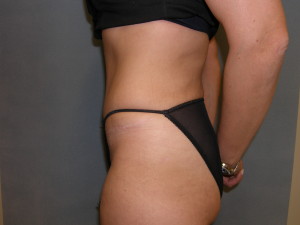 Tummy Tuck - Case 0106 - after side view