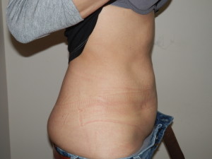 Liposuction - Case 0122 - after side view