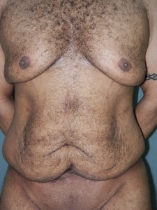 Body Contouring - Case 0085 - before front view