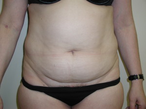 Tummy Tuck - Case 0106 - before front view