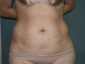 Liposuction - Case 0122 - before front view