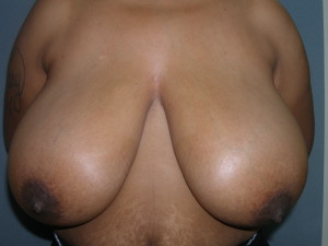 Breast Reduction - Case 0137 - before front view
