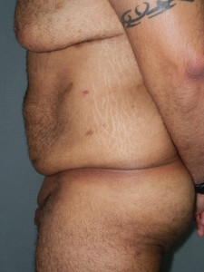 Body Contouring - Case 0085 - before side view