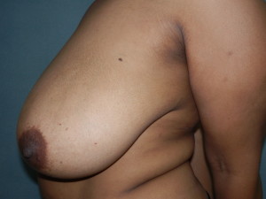 Breast Reduction - Case 0132 - before side view