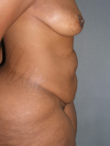 Body Contouring - Case 0093 - before side view