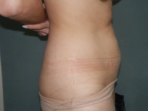 Liposuction - Case 0122 - before side view